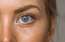 Blefaroplastika: Vai procedūru pēc gadiem nepieciešams atkārtot?